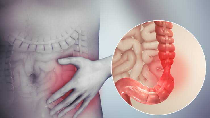 Irritable Bowel Syndrome ( IBS ) Treatment In Nashik