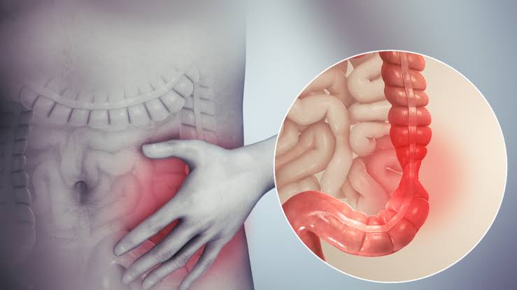 IRRITABLE BOWEL SYNDROME ( IBS ) TREATMENT in Nashik | Dr. Shreyans Shah